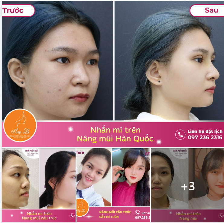 Trào lưu làm đẹp combo Mắt + Mũi tại Hiệp Lợi ngày càng nhận được nhiều sự quan tâm của các chị em