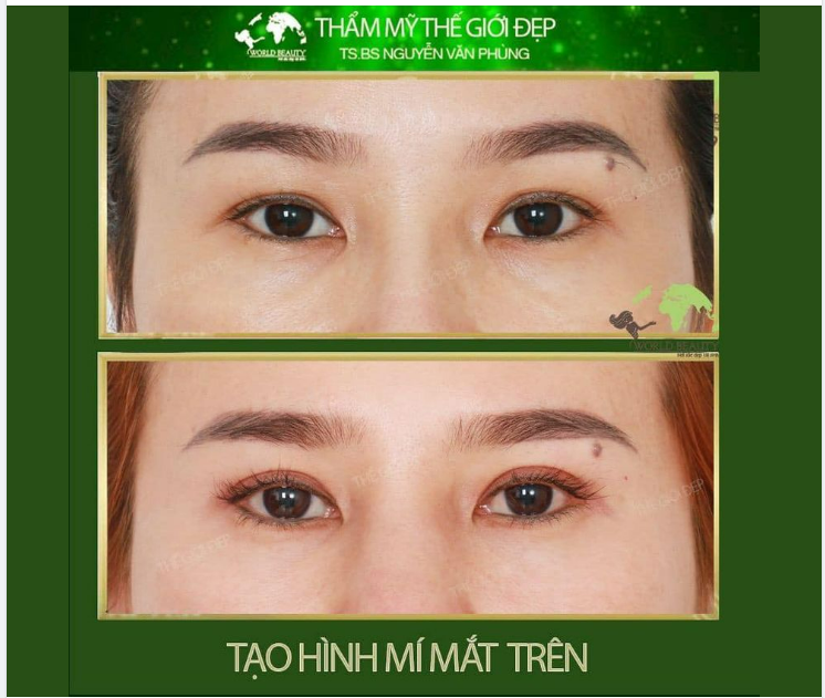​​​​​​​ Quý Cô có khuyết điểm ??̂́? ??́ ???̉, ???̂?? ??̂? đ?̂́? và muốn khắc phục bằng phẫu thuật tạo hình mí trên.