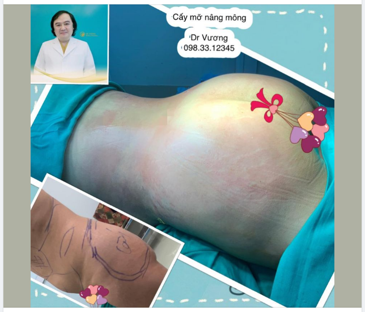 Cấy mỡ nâng mông với Dr Vương