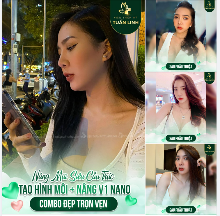 Nâng mũi siêu cấu trúc + Nâng V1 nano + Tạo hình môi trái tim . Combo cho nhan sắc đẹp trọn vẹn.