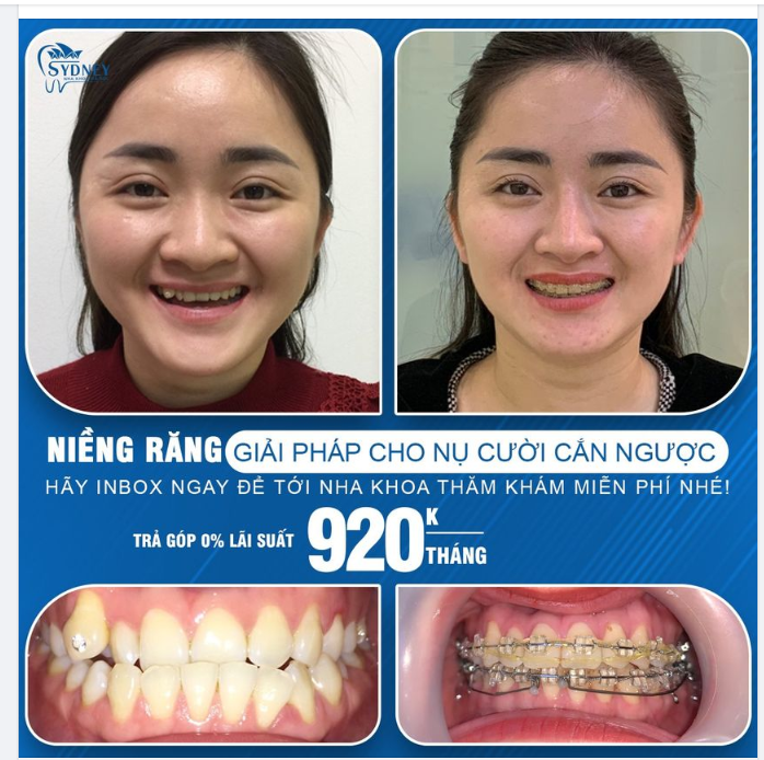 Niềng răng giải pháp hoàn hảo cho khớp cắn ngược