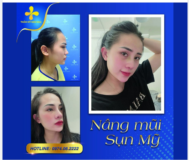 Cận cảnh góc nghiêng của khách hàng trước và sau khi nâng mũi sụn mỹ.