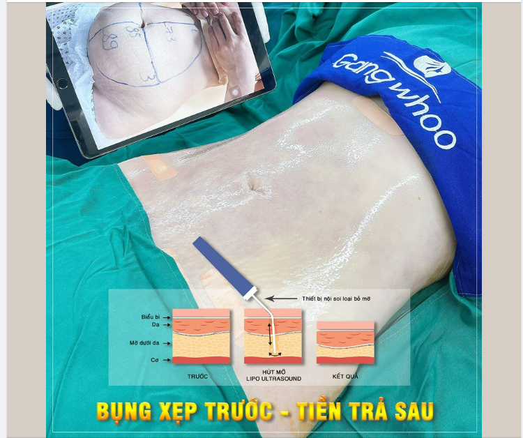 BỤNG XẸP TRƯỚC - TIỀN TRẢ SAU - DÁNG ĐẸP KHÔNG LO CHI PHÍ