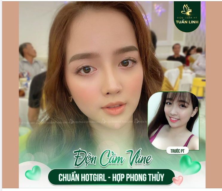 Độn cằm Vline- Giá chỉ từ 15 tr  Với kỹ thuật độn cằm tiên tiến hiện đại sẽ giúp bạn: