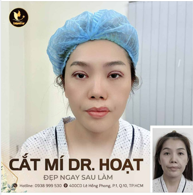 CẮT MÍ DR. HOẠT – ĐẸP NGAY SAU LÀM