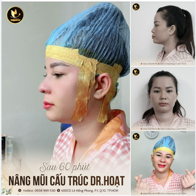 “Thấy em mình làm mũi xong đẹp quá, mình cũng thích làm dáng mũi đẹp hơn, cao hơn và dài hơn dáng mũi hiện tại”