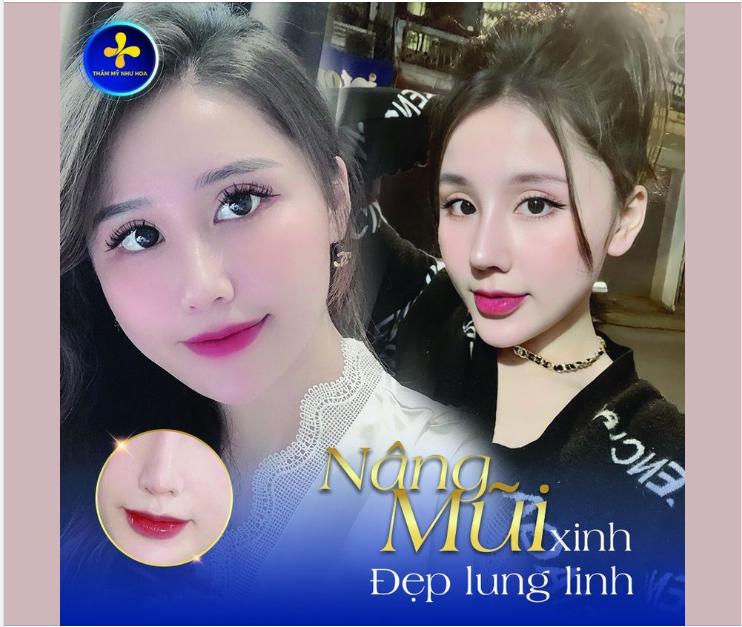 Nhiều khách hàng có nhu cầu nâng mũi nhưng không biết nên lựa chọn cơ sở thẩm mỹ nào? Sau khi tham khảo nhiều nơi, khách hàng đã quyết định đến Thẩm mỹ Như Hoa để được tư vấn!