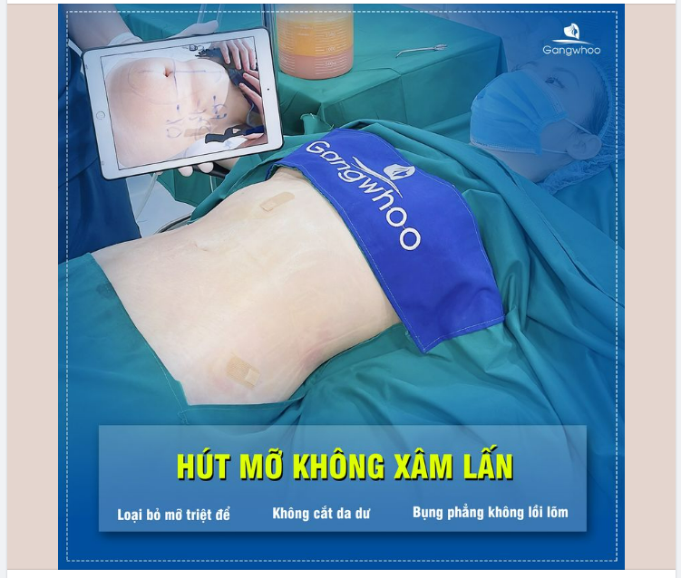 BỤNG ĐẸP TỪ CÔNG NGHỆ HÚT MỠ KHÔNG PHẪU THUẬT - KHÔNG XÂM LẤN