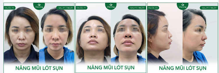 Dáng mũi cũ dù có đủ sóng, đủ dài nhưng lại không đủ cao để khiến khuôn mặt nổi bật.