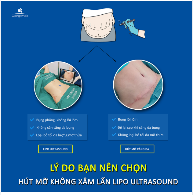 LÝ DO BẠN NÊN CHỌN HÚT MỠ KHÔNG XÂM LẤN - LIPO ULTRASOUND