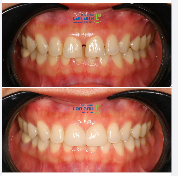  Một trường hợp làm Veneer sứ 2 răng cửa tại chi nhánh Sala, bác sĩ Hiền điều trị!