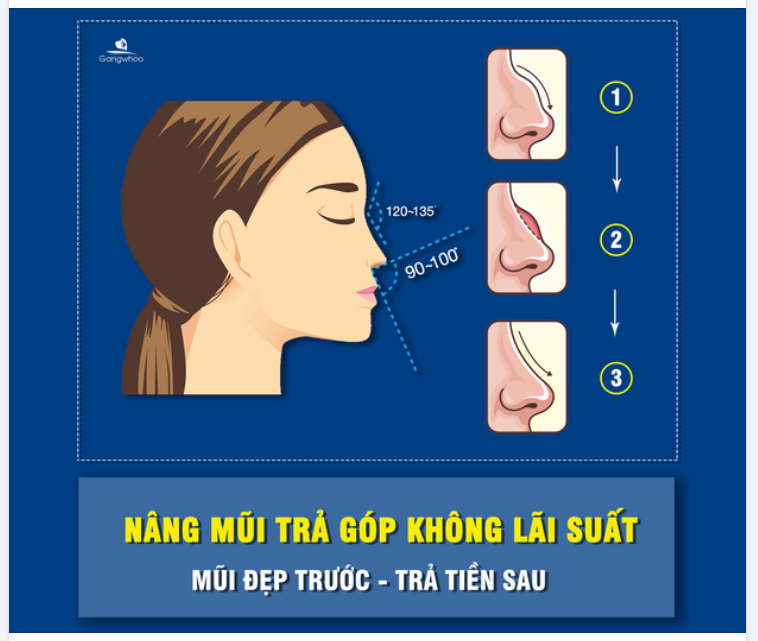 NÂNG MŨI TRẢ GÓP KHÔNG LÃI SUẤT - MŨI ĐẸP TRƯỚC, TIỀN TRA SAU