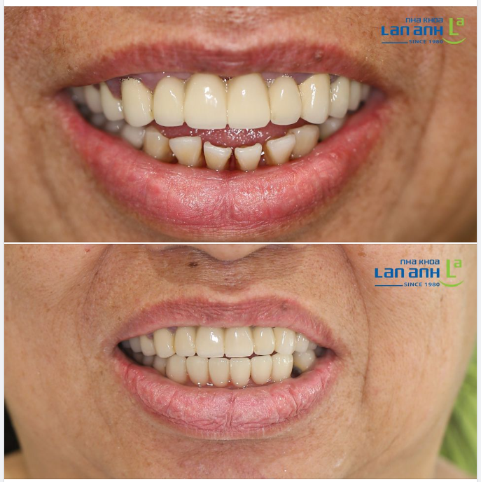 Một trường hợp làm lại răng sứ của chi nhánh Sala, quận 2, bác sĩ Liên điều trị!