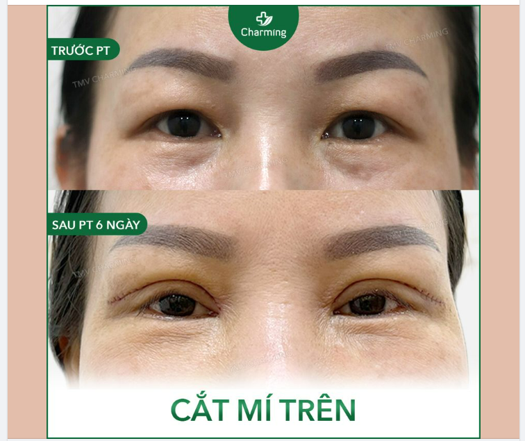 Đây là một trường hợp sụp mí nhưng không có nhiều da chùng.