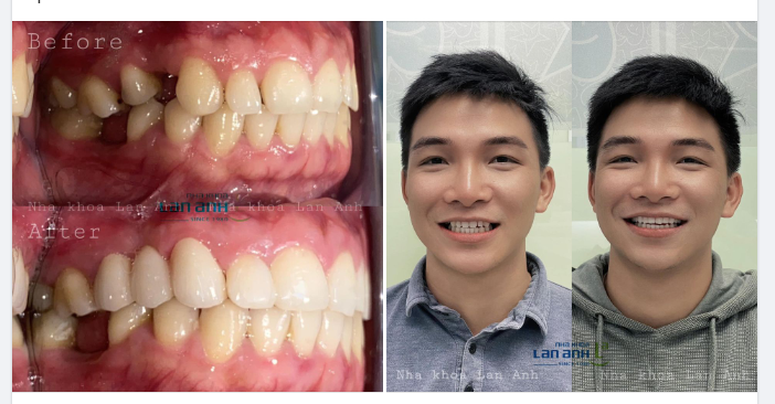 1 case phục hình răng bị mất và trám răng của BS Thủy- chi nhánh 292 Huỳnh Văn Bánh, Phú Nhuận.