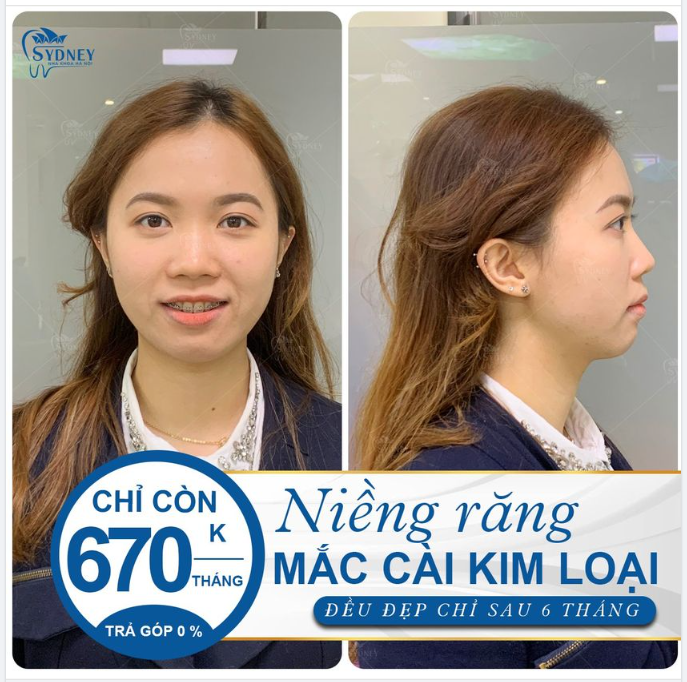 Bạn có nghĩ niềng răng thay đổi khuôn mặt?