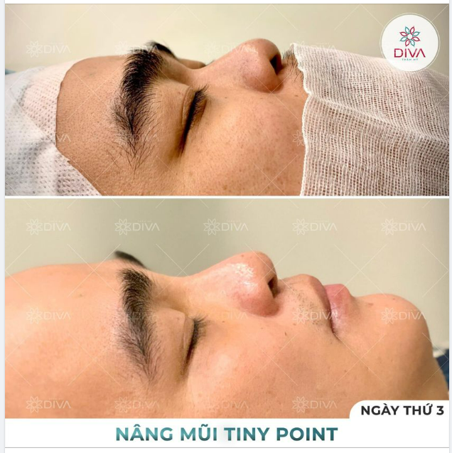 MŨI GÃY SÂU NGANG MẮT: PHƯƠNG PHÁP NÀO CẢI THIỆN TỐT NHẤT?