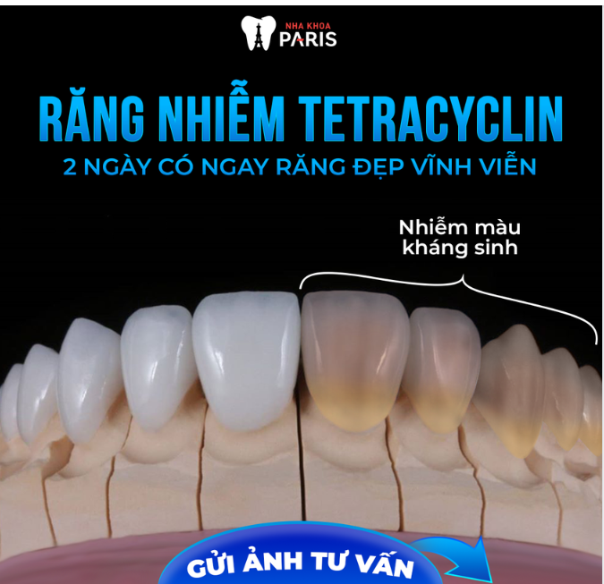 KHẮC PHỤC RĂNG NHIỄM TETRACYCLIN