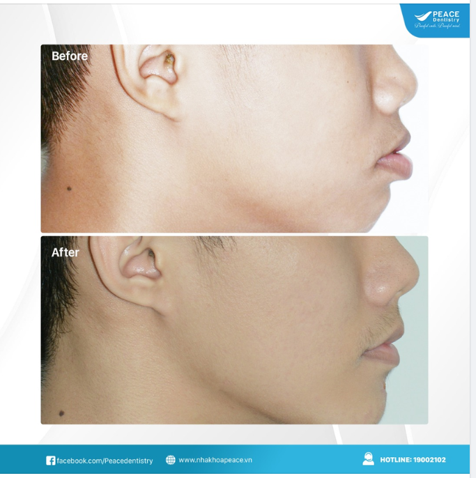 Quan trọng nhất là nụ cười của bạn đã đẹp hơn, khuyết điểm của góc nghiêng hoàn toàn được cải thiện.