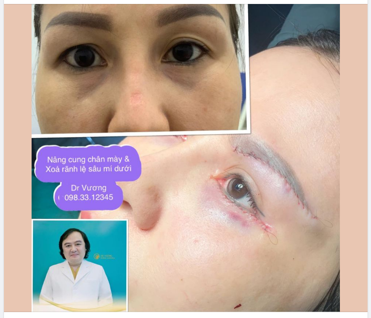 Nâng cung chân mày với Dr Vương: