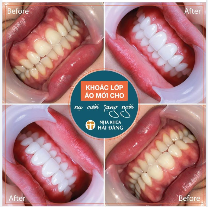 KHOÁC ÁO MỚI CHO NỤ CƯỜI RẠNG NGỜI