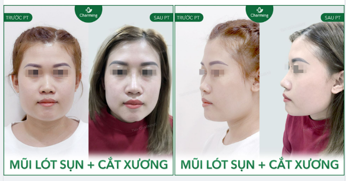 Khi khuôn mặt to, xương nền mũi của bạn cũng có xu hướng bè sang hai bên, khiến chiếc mũi bạn trông như một hình tam giác thô cứng nằm giữa khuôn mặt.