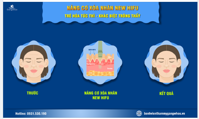 CÔNG NGHỆ NÂNG CƠ NEW HIFU - TRẺ HÓA TỨC THÌ, KHÁC BIỆT TRÔNG THẤY