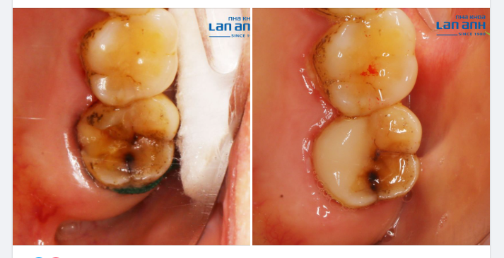 Một trường hợp làm Onlay sứ tại chi nhánh Sala, bác sĩ Lệ điều trị!
