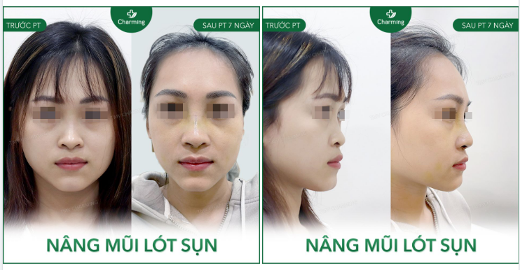 Chóp mũi của bạn cũng có độ cao đầy hứa hẹn, khổ nỗi là sóng mũi lại không chịu hợp tác.