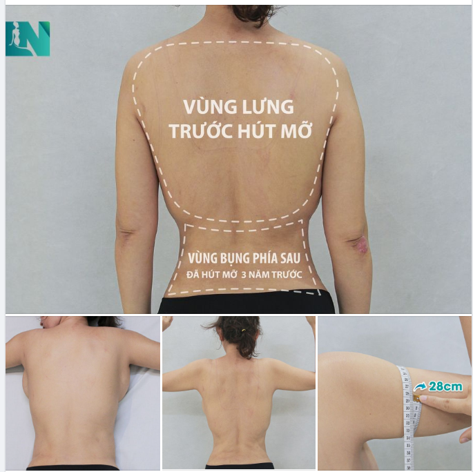  HÚT HÚT MỠ TẠO DÁNG THẨM MỸ TAY, LƯNG, NÁCH  CẤY MỠ TẠO DÁNG VÒNG 3 CHO CHỊ KH THUÝ NGA ĐẾN TỪ ĐỒNG NAI. 
