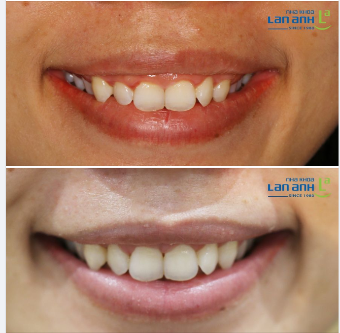 Một trường hợp cắt nướu của bác sĩ Liên, chi nhánh Sala, quận 2!