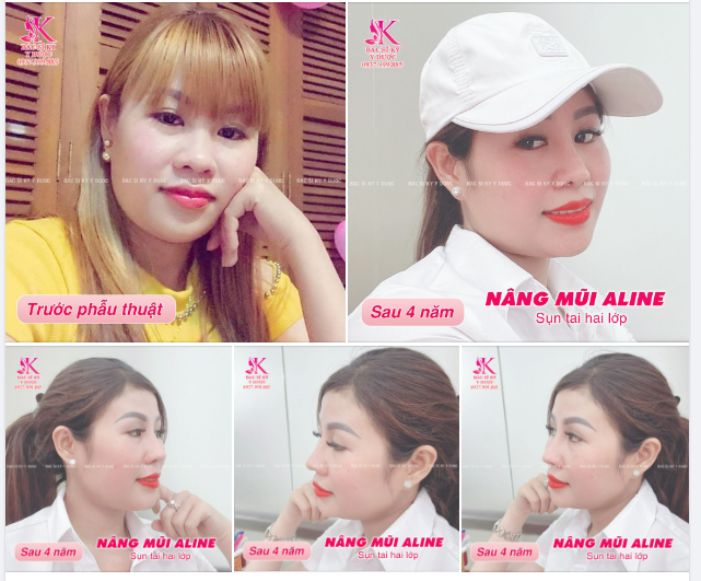 KẾT QUẢ NÂNG MŨI ALINE SỤN TAI HAI LỚP CỦA BẠN KHÁCH SAU 4 NĂM