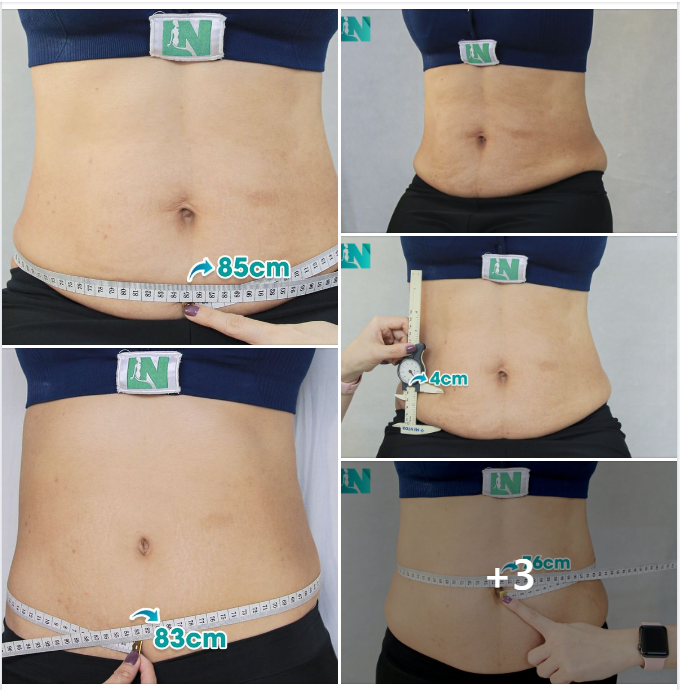 HÚT MỠ TẠO DÁNG THẨM MỸ KẾT HỢP  CẤY MỠ TRẺ HOÁ KHUÔN MẶT CHO CÔ KH (57 TUỔI) ĐÃ HÚT MỠ TẠI EKIP BÁC SĨ LƯƠNG NGỌC 3 NĂM TRƯỚC.