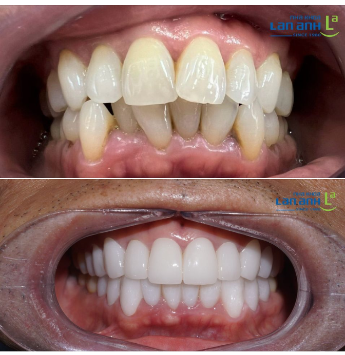 Răng Sứ Thẩm Mỹ - Sứ Cercon hãng Denstply Sirona - sản xuất tại Đức.