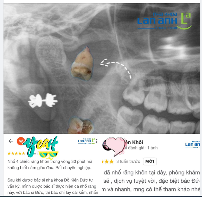 Nhổ răng khôn (răng số ​​​​​​​) là kỹ thuật dễ hay khó?