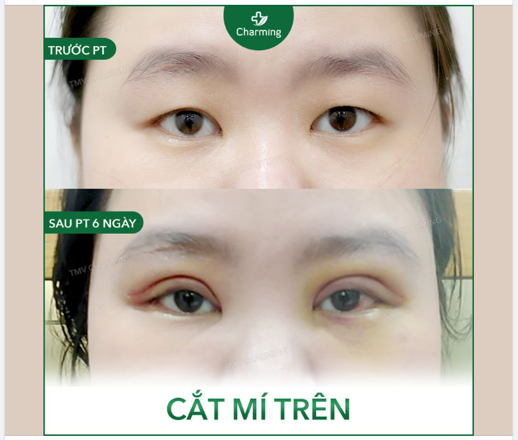Trông đôi mắt cứ ngỡ là một mí nhưng nhìn kỹ thì đến 2 mí cơ đấy . Chỉ là mí kia giấu mình kỹ quá thôi. Không sao, không sao