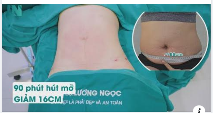 Trong 90 phút – làm thế nào để giảm mỡ và tạo vòng eo thắt đáy cho vùng bụng thừa mỡ?