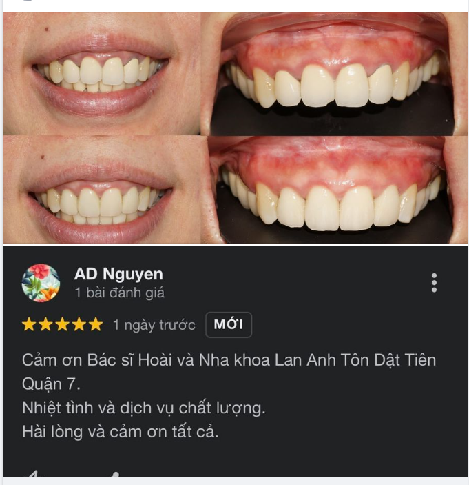 Cảm ơn chị khách hàng đã đặt niềm tin vào Bác sĩ Hoài phục hình lại răng sứ Lava 3M tại chi nhánh 149 Tôn Dật Tiên-Quận 7 ạ