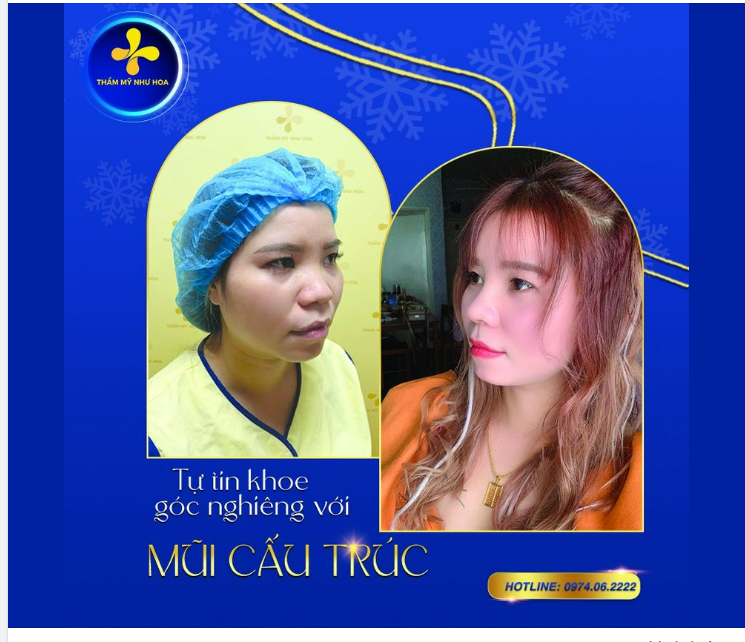 Nâng mũi cấu trúc, giúp bạn sở hữu sống mũi cao nổi bật, đầu mũi bay, thon gọn và không sưng bầm.