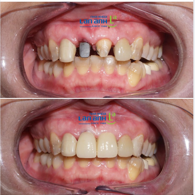 Nha khoa luôn đặt tâm lý khách lên hàng đầu nên sau khi cấy ghép implant, bác sĩ sẽ làm phục hình tạm ngay lập tức để giải quyết vấn đề thẩm mỹ cho khách.