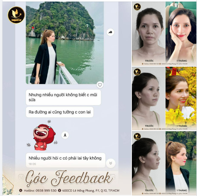 Chiếc feedback sau hơn 1 tháng nâng mũi tại Bác sĩ Hoạt của chị Hồng Gấm.