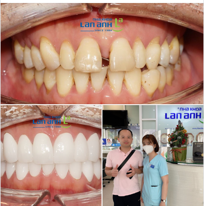 Nếu bạn có cá tính, và thích màu răng trắng thật trắng...