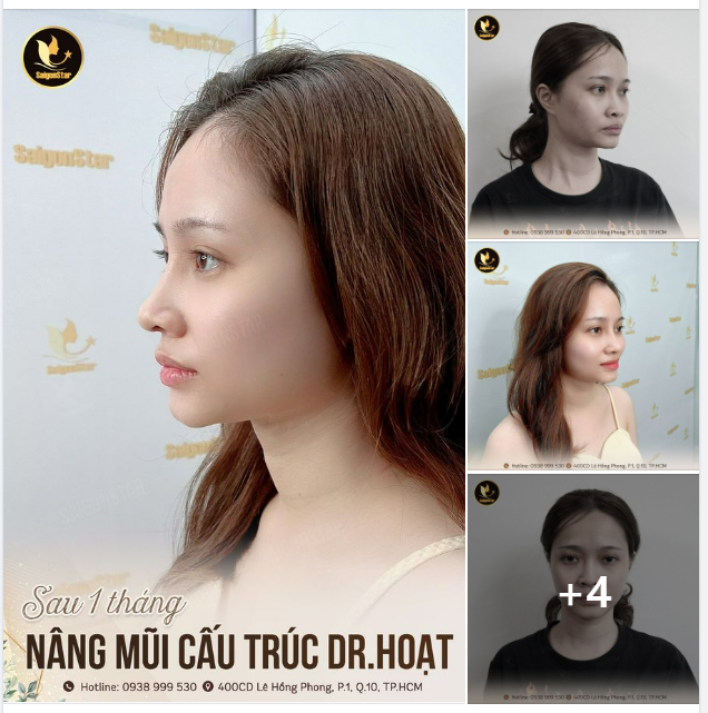 SAU 1 THÁNG NÂNG MŨI CẤU TRÚC DR. HOẠT