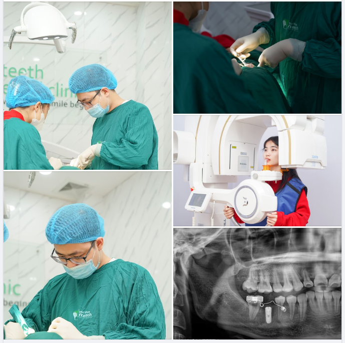 3 tháng là khoảng thời gian tối ưu nhất để có thể phục hình răng sứ bên trên trụ implant để giúp bạn ăn nhai tốt.