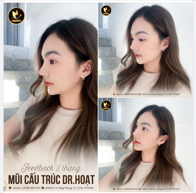 FEEDBACK 2 THÁNG MŨI CẤU TRÚC DR. HOẠT