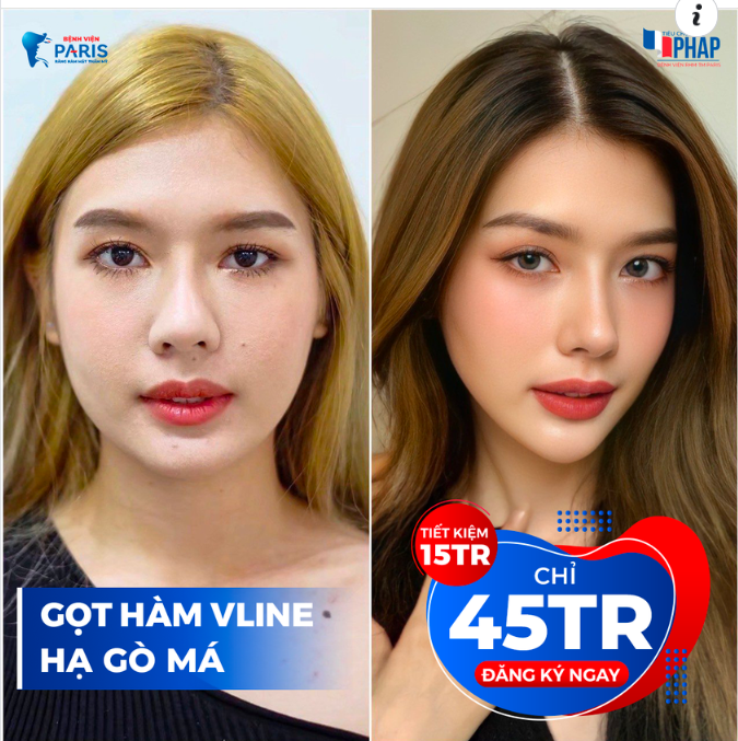 Gọt hàm Hạ gò má - Góc nghiêng thần thánh