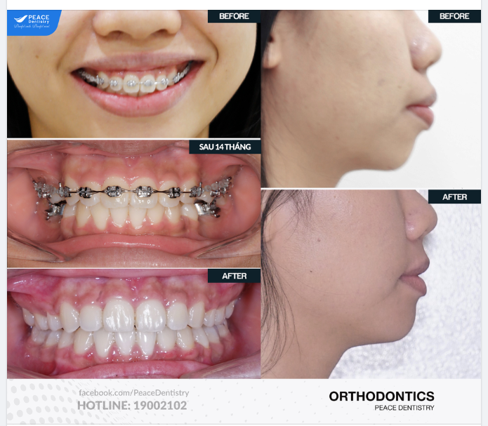 Ở ĐÂY CÓ NIỀNG RĂNG GÂY TIẾC NUỐI VÌ SAO KHÔNG NIỀNG SỚM HƠN