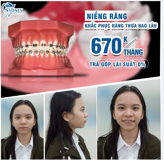Niềng răng thưa mất bao lâu?