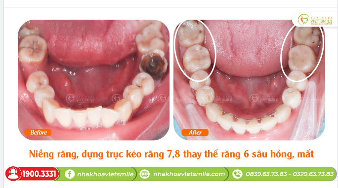 NIỀNG RĂNG DỰNG TRỤC, KÉO R7,8 THAY THẾ R6 SÂU HỎNG, MẤ.T