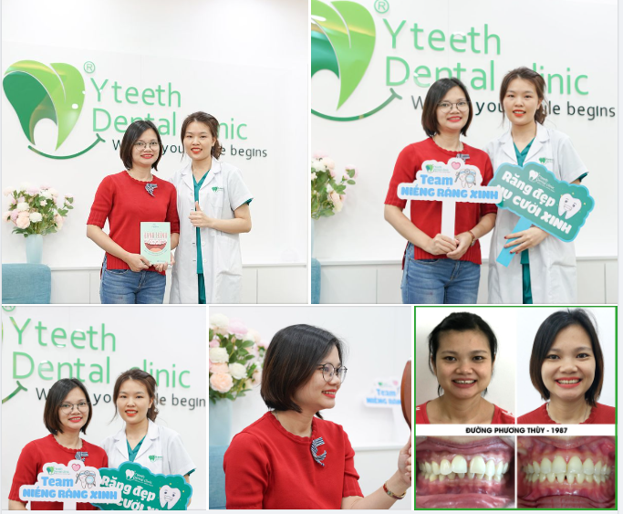 Một sự thay đổi khó có thể nhận ra sau khi niềng răng của khách hàng Đường Phương Thùy tại nha khoa Yteeth.